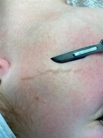 Dermaplaning van het gezicht schoonheidssalon Hoogeveen