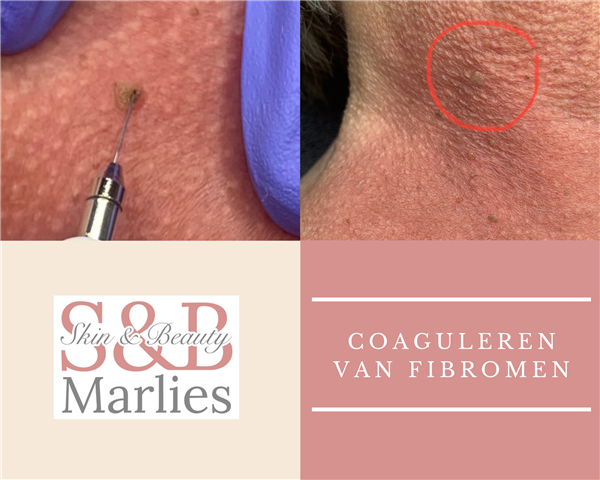 Coaguleren oftewel verwijderen van steelwratjes fibromen couperose en andere huid oneffenheden in Hoogeveen
