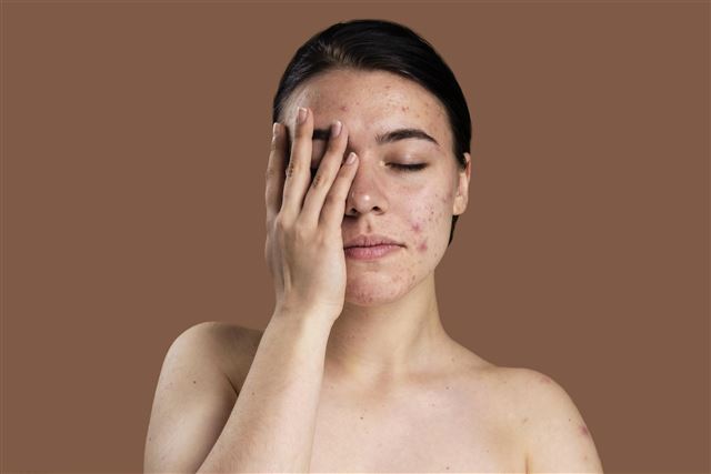Behandeling van een acnehuid skin&beauty Hoogeveen schoonheidssalon