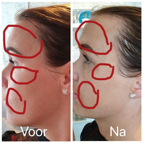 Resultaat van een bindweefselmassage bij Skin & Beauty Marlies te Hoogeveen