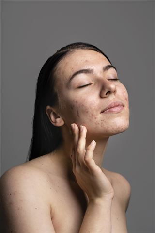 Acne behandeling schoonheidssalon littekens roodheid huidverbetering Hoogeveen schoonheidsspecialist