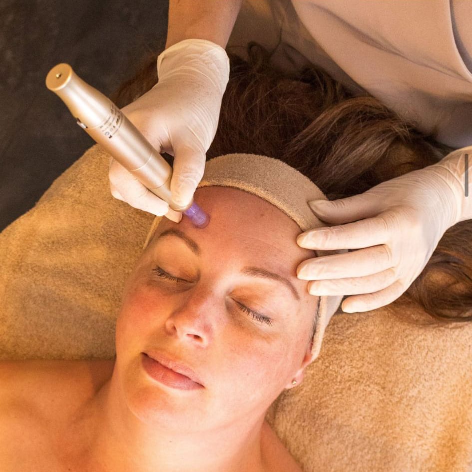 Microneedling Skin Beauty Marlies schoonheidssalon anti-age acne littekens pigmentvlekken